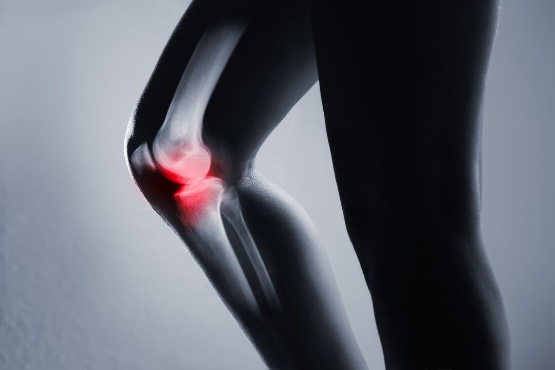 Kniegelenkentzündung bei Arthrose