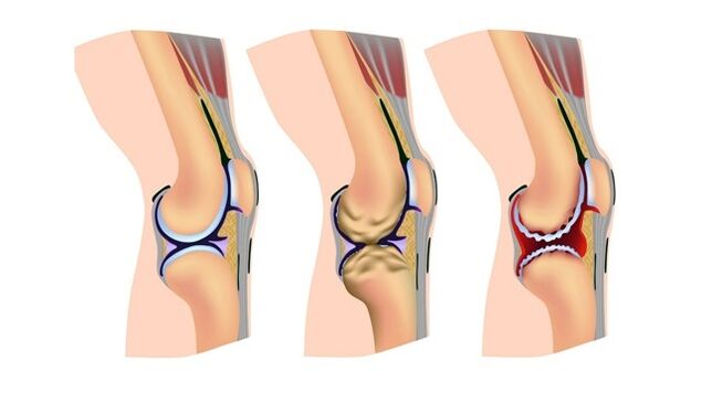 Stadien der Arthrose des Kniegelenks