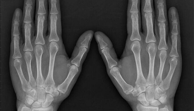 Röntgen für die Diagnose von Arthritis und Osteoarthritis