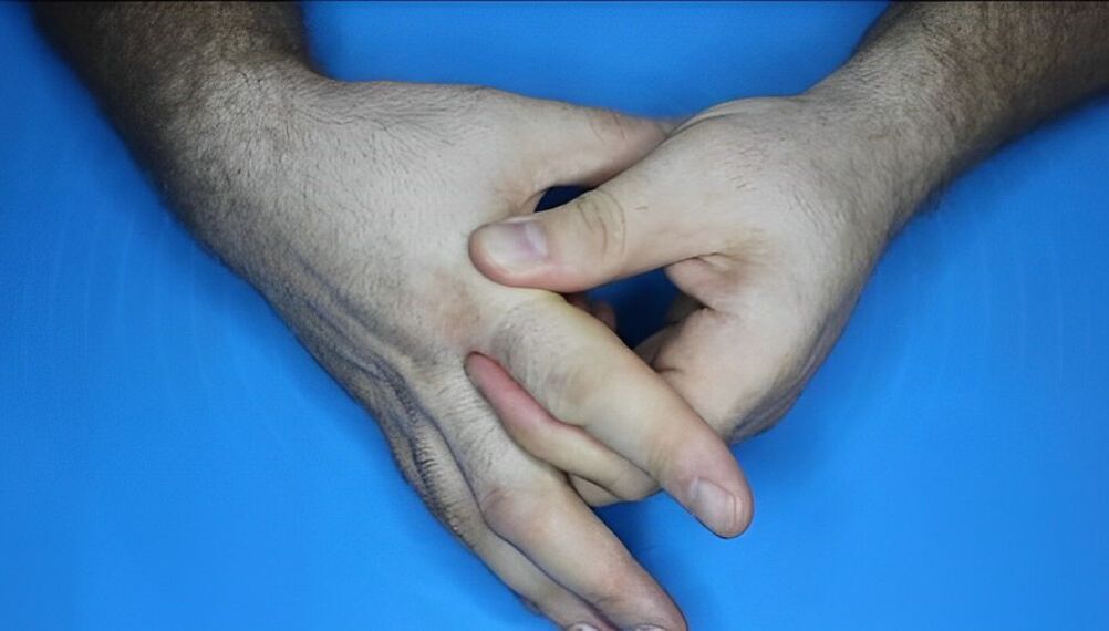 Übungen für Finger bei Arthrose