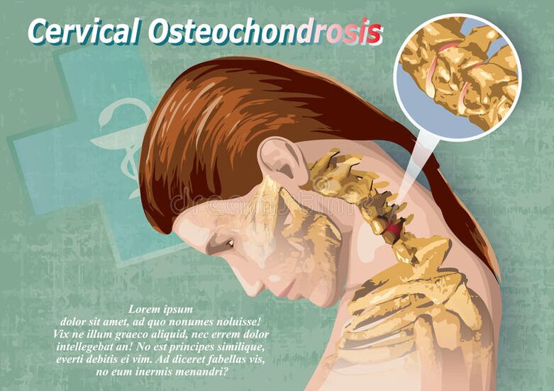 Die zervikale Osteochondrose ist eine Erkrankung des Knorpelgewebes.