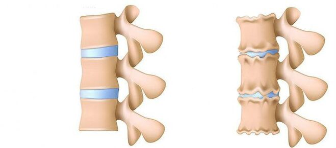Osteochondrose von innen.